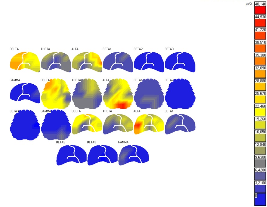 Representación gráfica de mapeo EEG